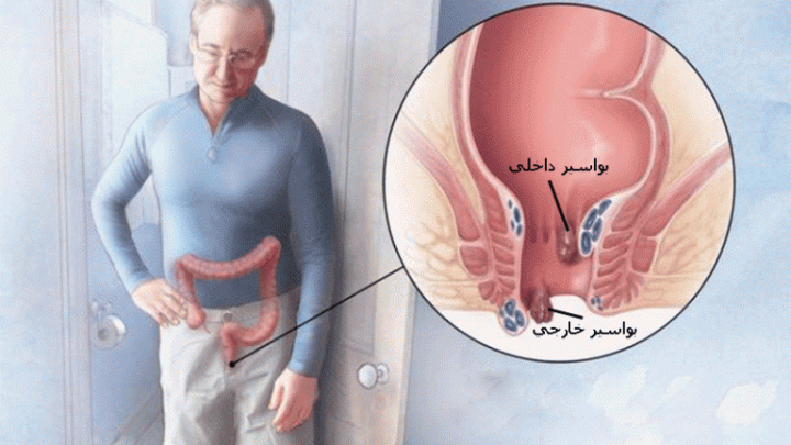 بواسیر یا هموروئید چیست/راه های درمان با لیزر، سریع و قطعی بدون عمل جراحی